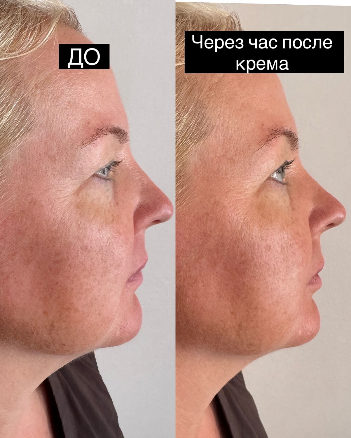 Базовый набор лимфодренажный от отечности лица и опущенного века